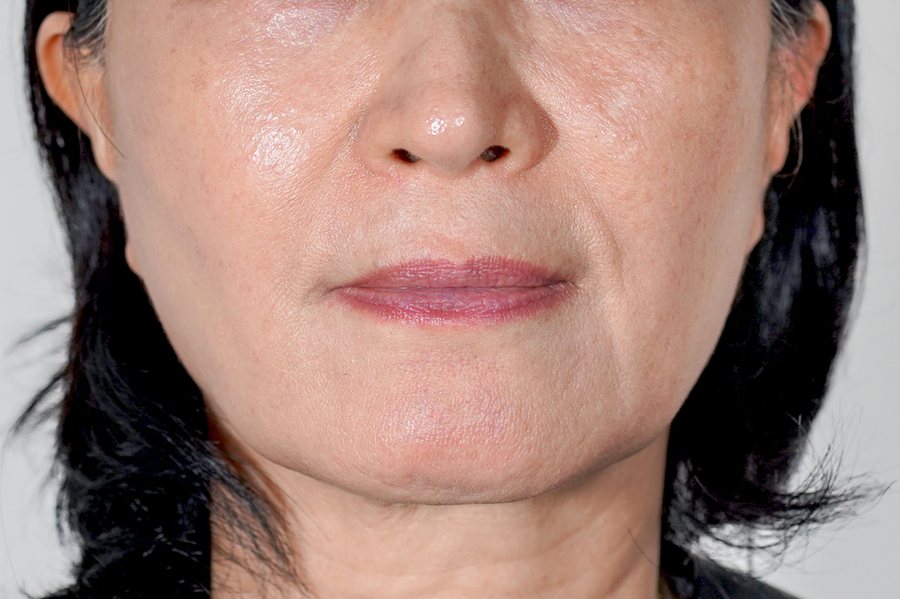 Juvéderm at MILI Clinic Dosan — before, case 1