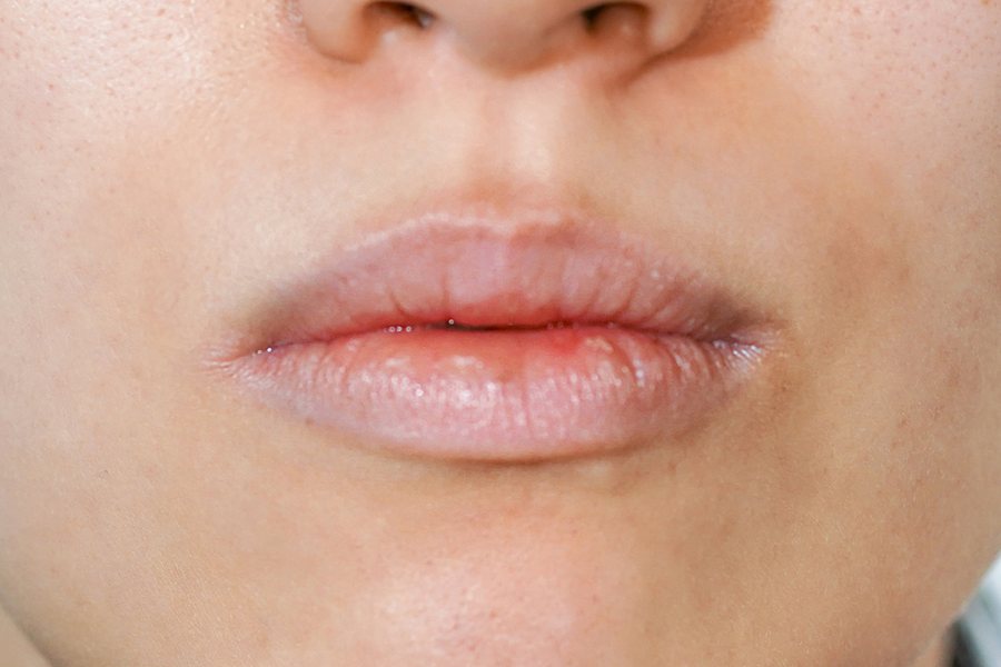 Juvéderm at MILI Clinic Dosan — before, case 2