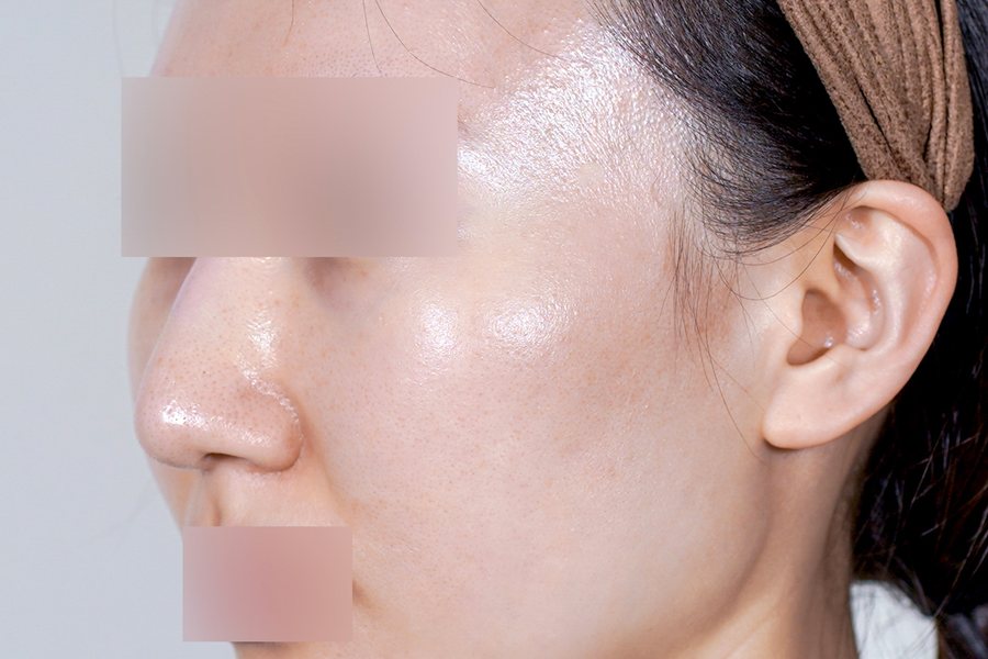 Derma Renewal at MILI Clinic Dosan — before, case 1