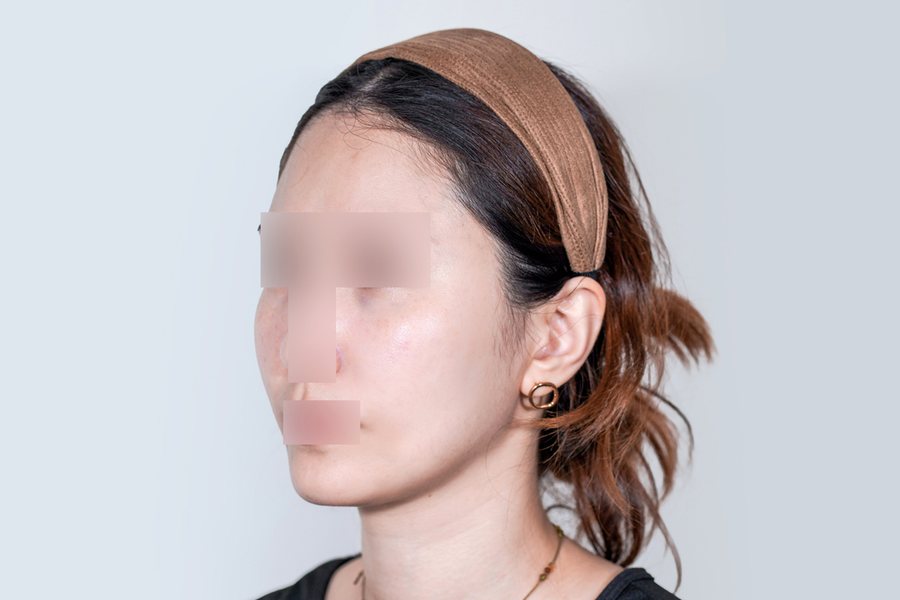 Sculptra at MILI Clinic Dosan — after, case 1