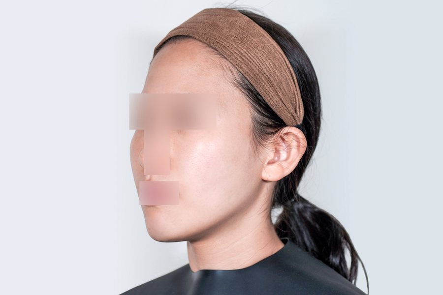 Sculptra at MILI Clinic Dosan — after, case 2