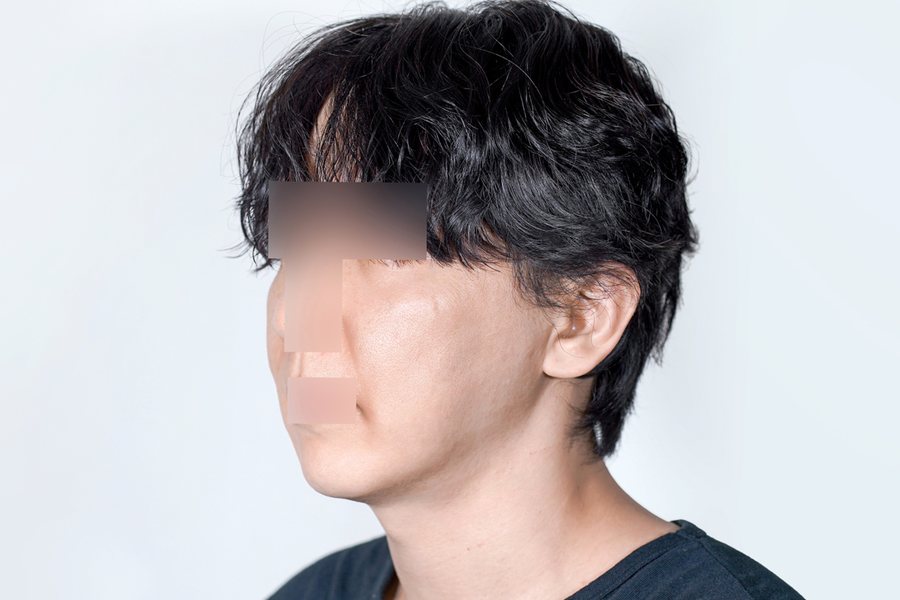 Thermage FLX at MILI Clinic Dosan — before, case 1