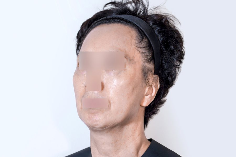Thermage FLX at MILI Clinic Dosan — before, case 2