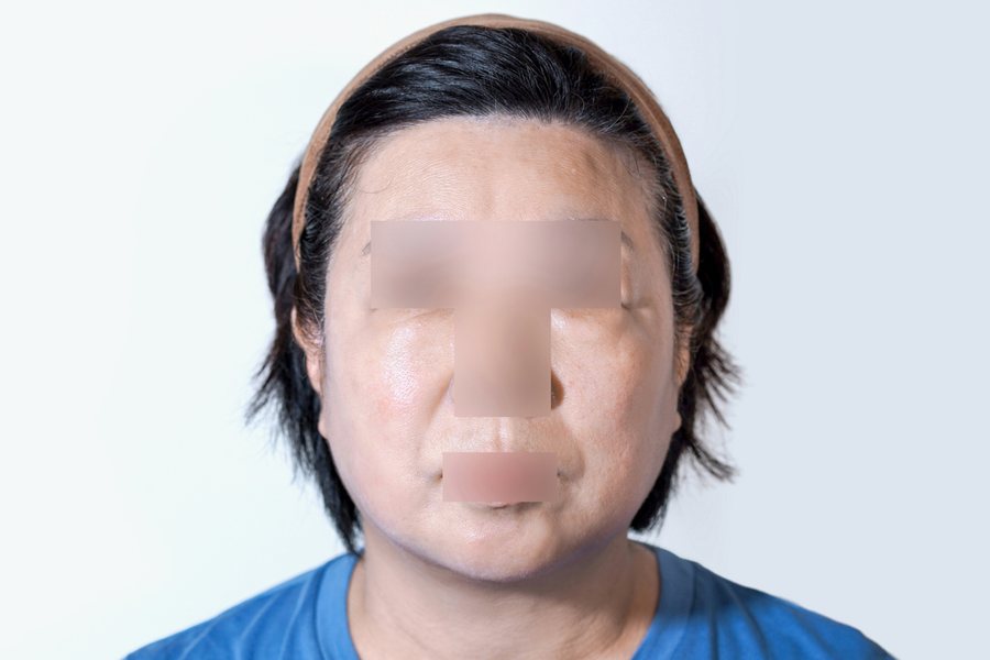 Silhouette Soft at MILI Clinic Dosan — after, case 1