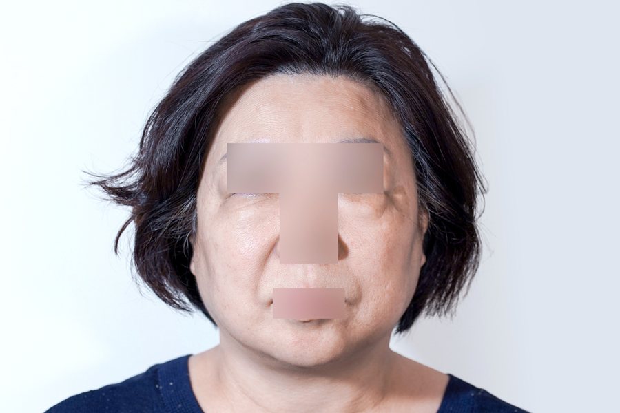 Silhouette Soft at MILI Clinic Dosan — before, case 1