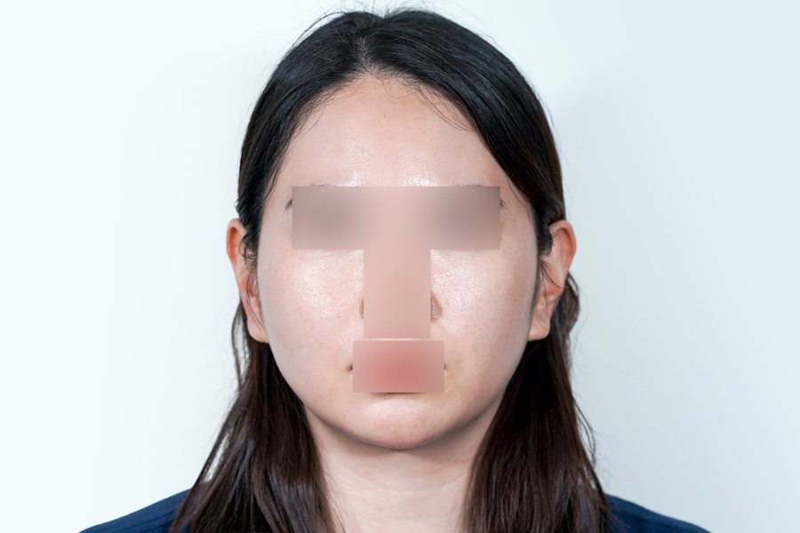 Silhouette Soft at MILI Clinic Dosan — after, case 2