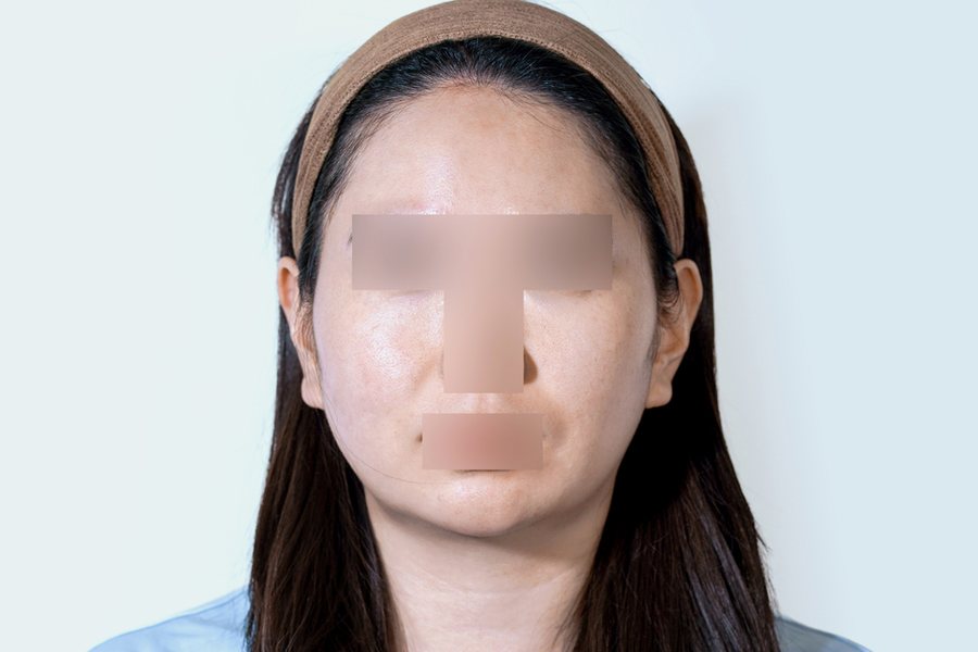 Silhouette Soft at MILI Clinic Dosan — before, case 2