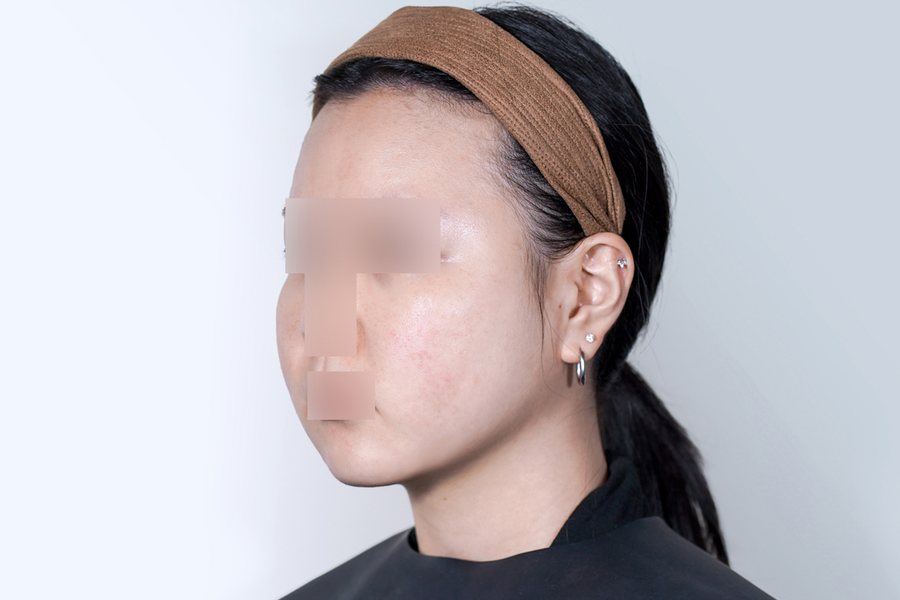 Tuneface at MILI Clinic Dosan — after, case 1