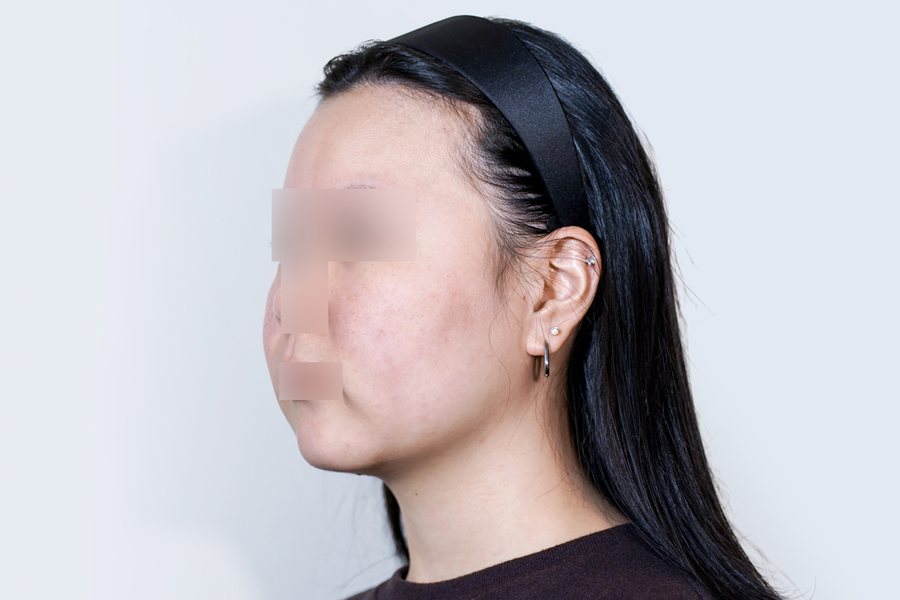 Tuneface at MILI Clinic Dosan — before, case 1