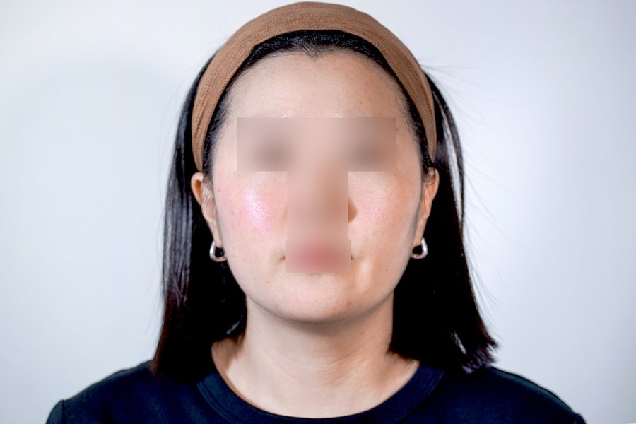 Ultherapy Prime at MILI Clinic Dosan — after, case 1