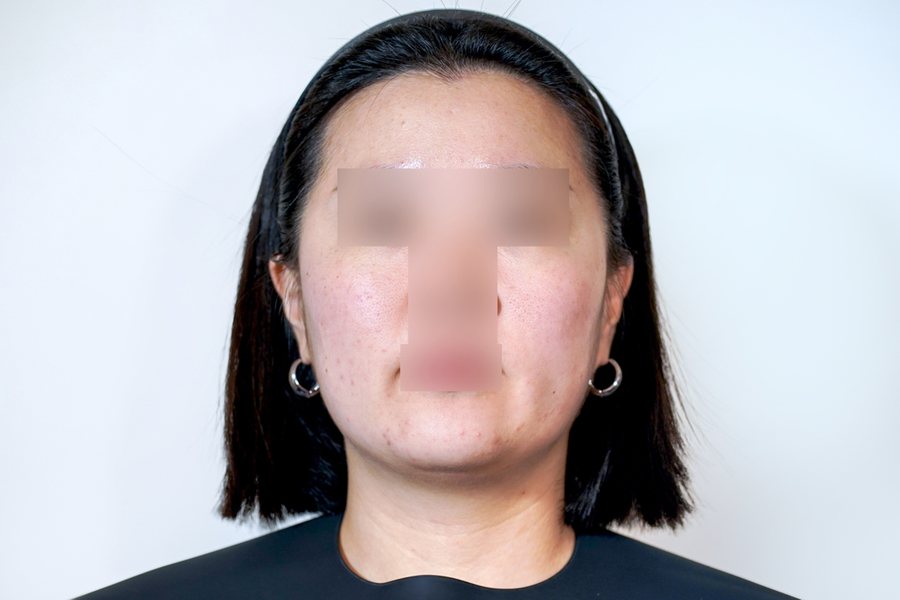 Ultherapy Prime at MILI Clinic Dosan — before, case 1