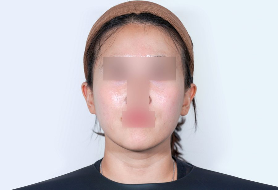 Ultherapy Prime at MILI Clinic Dosan — after, case 2